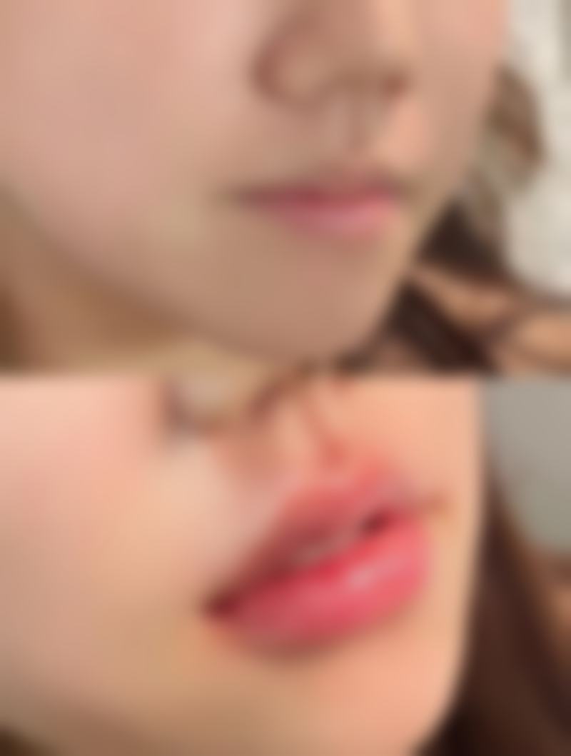 北京画美医疗美容割双眼皮后遗症情况如何