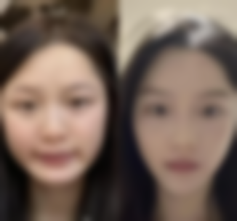 呼和浩特京美医疗美容医院割双眼皮后遗症情况怎么样