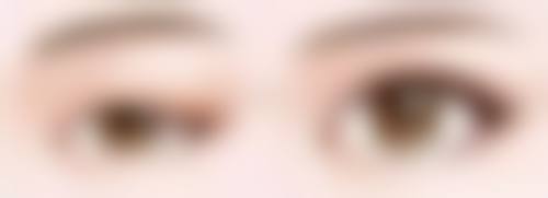 北京圣嘉新医疗美容医院做哪种双眼皮手术好？