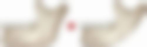 芮尔隆胸假体柔软度靠谱吗？