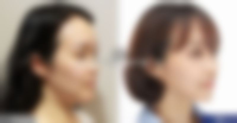 碧波隆胸假体柔软度怎么样？