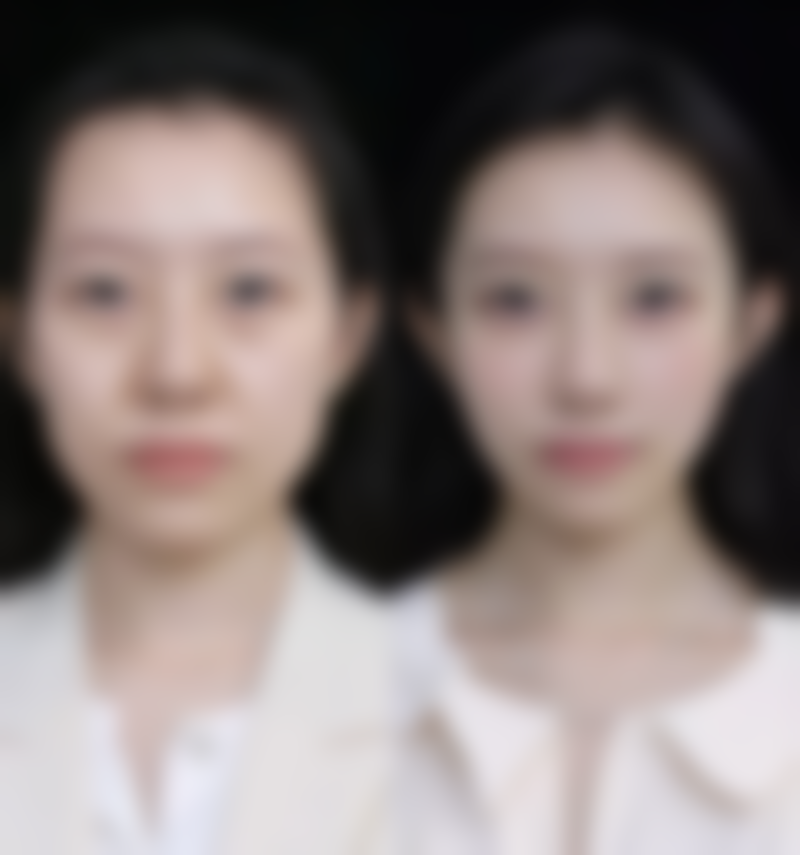 使用Sculptra塑然雅改善小孩积食眼袋深值不值？