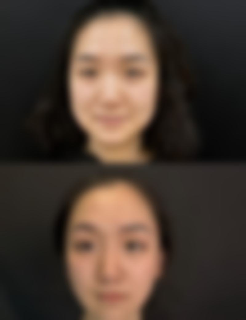 北京京城皮肤病医院整形美容中 心真实实例