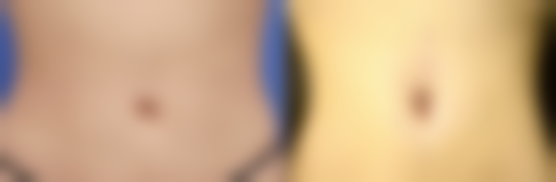 成都军建医院去除黑眼圈眼袋靠谱吗