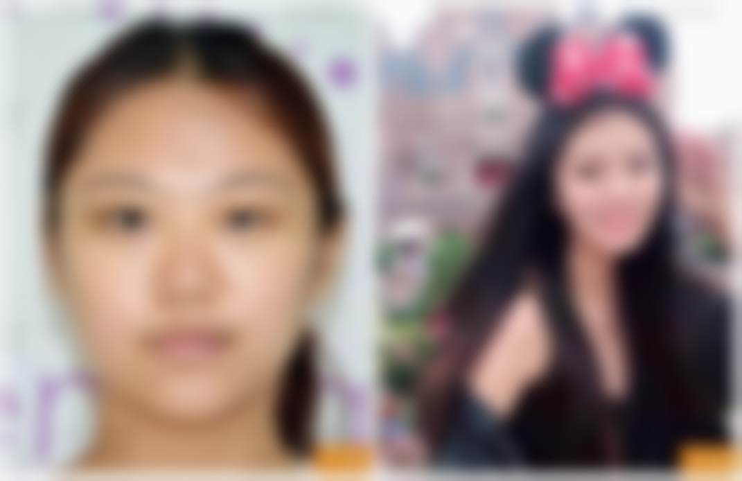 曼托水滴假体价格优势