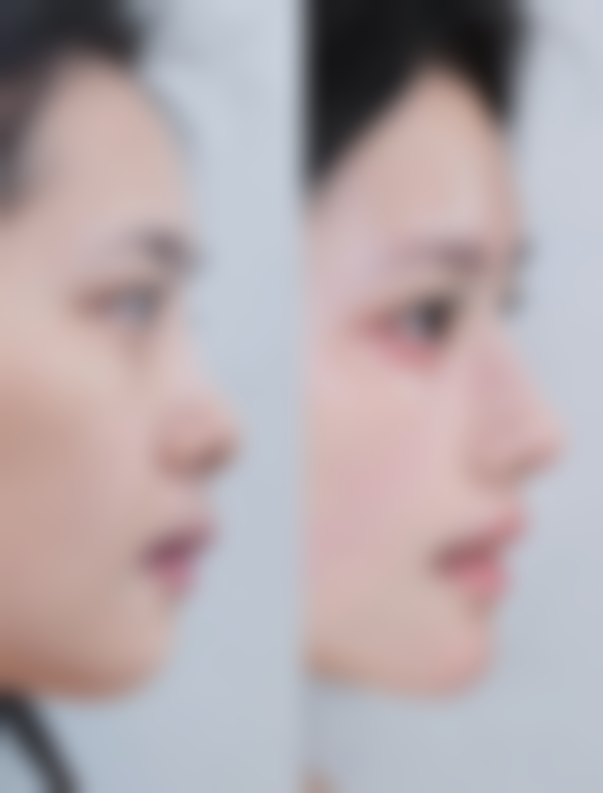 惠州诗凡贝医疗美容诊所真实实例