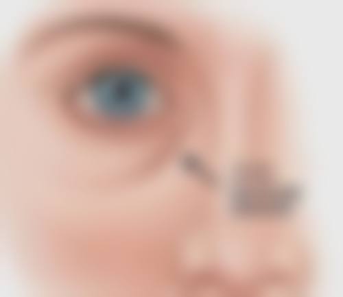 7.5毫米双眼皮的手术风险大吗