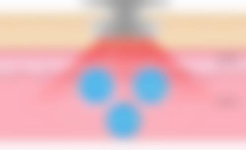 北京画美医疗美容医院的隆鼻材料适合我吗