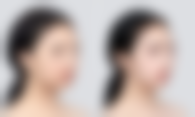 韩国 BIO 整形淡化面部疤痕适合吗