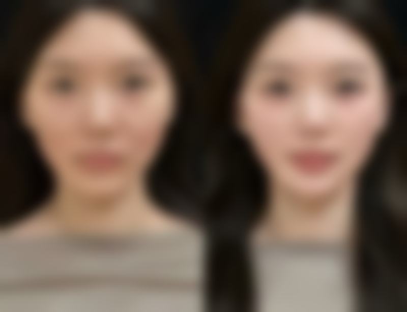 隆胸做小了去韩国整容医院修复怎么样？