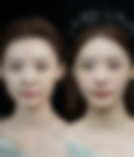 北京画美医疗美容外切双眼皮修复完全自然值不值