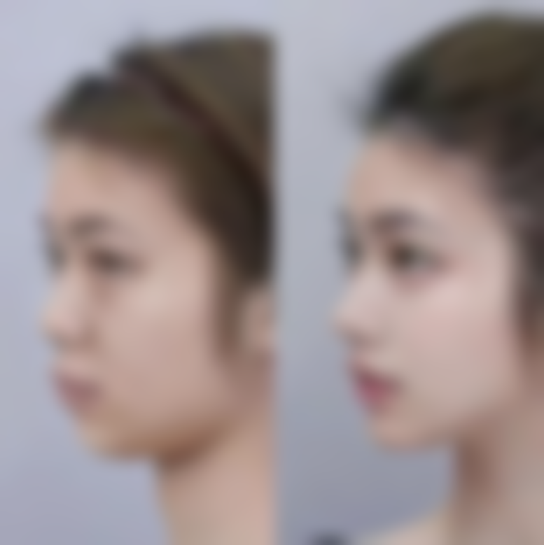 通辽张大夫医疗整形美容院真实实例