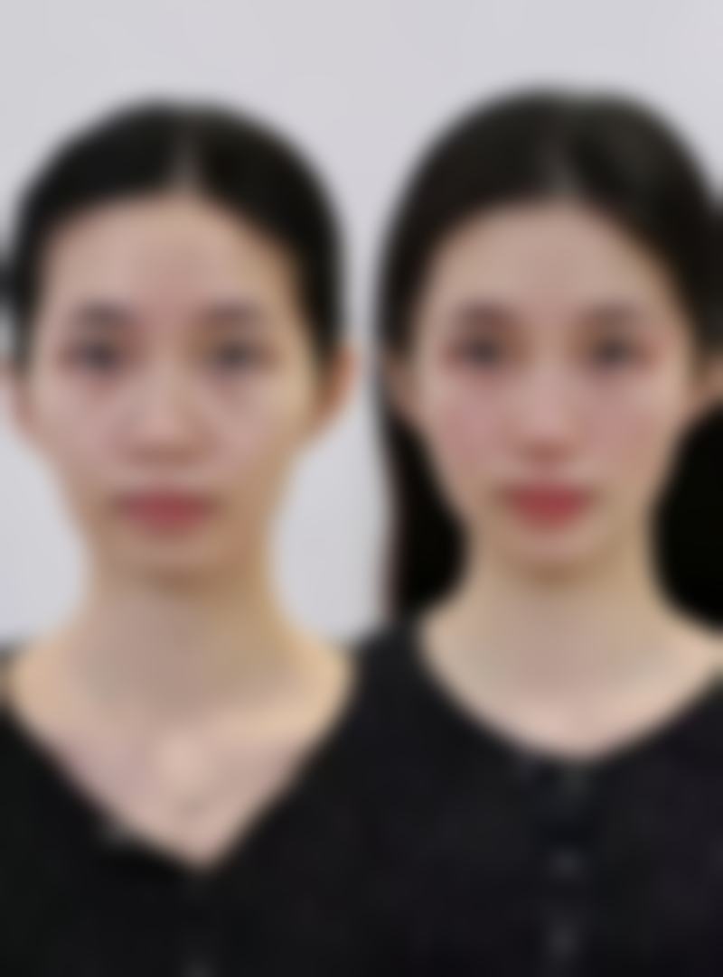 武汉斯启诺医美面部注射精细化雕刻的成功实例