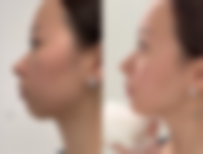 大连爱德丽格医疗美容王香平医生去眼袋适合小创口需求者吗？