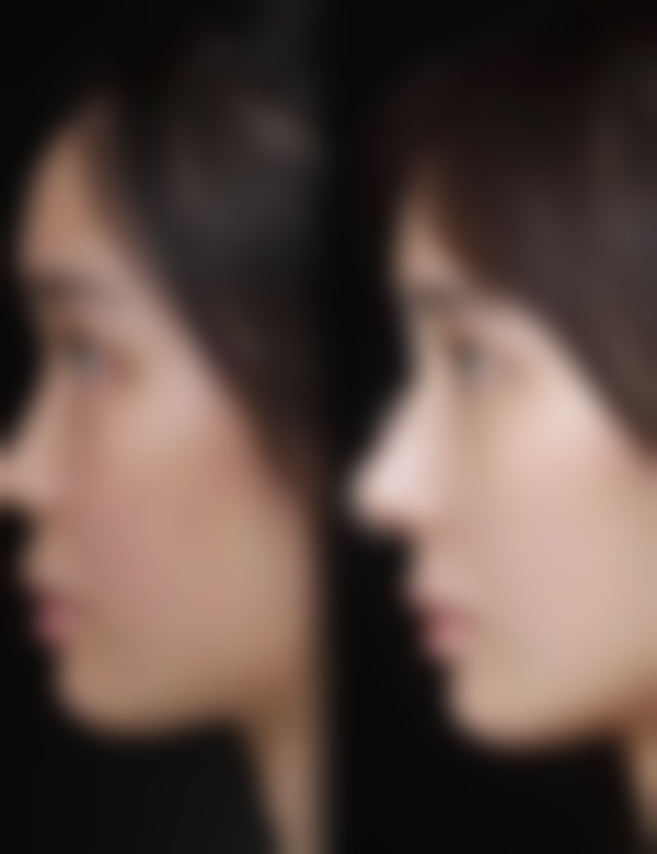 北京圣嘉新医疗美容医院种植头发价格受医生技术影响大吗？