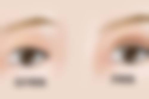 北京画美医疗美容自体脂肪隆胸怎样加快变软速度