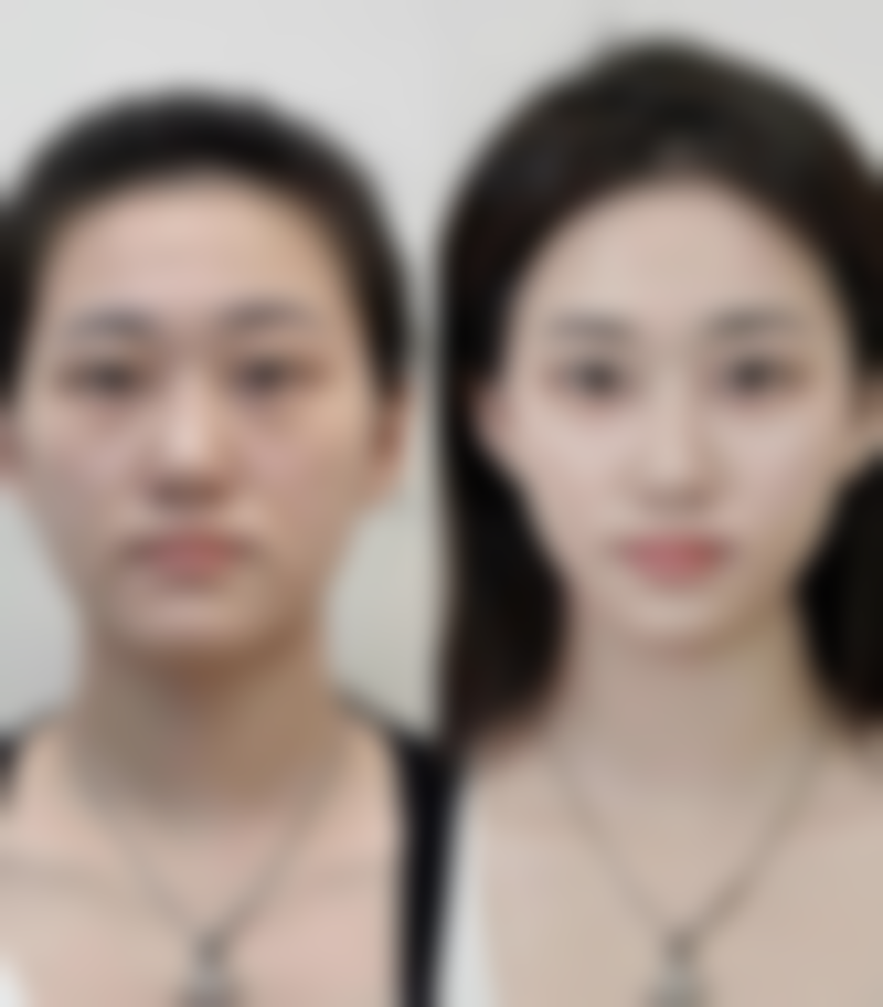 北京圣嘉新医疗美容医院如何缩短双眼皮增生修复时间？