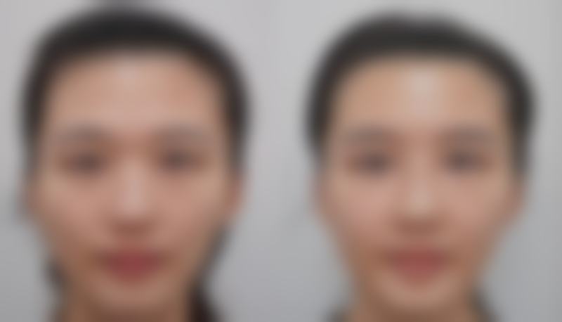 隆胸手术的修复时间靠谱吗？