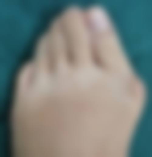 吸脂肪术后修复时间长吗？