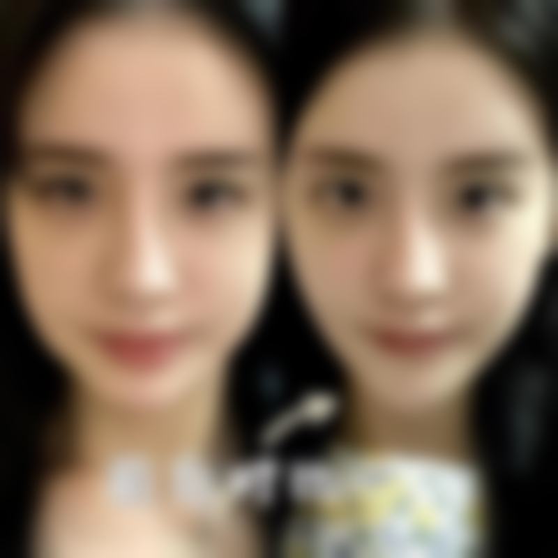 武科 大附属紫荆医院医疗美容科注射双眼皮怎么样