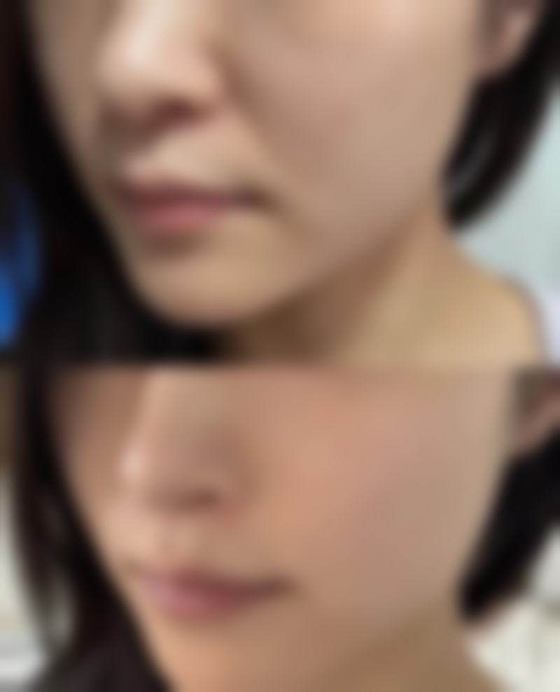 沈阳杏林整形医院去除下眼袋脂肪粒靠谱吗