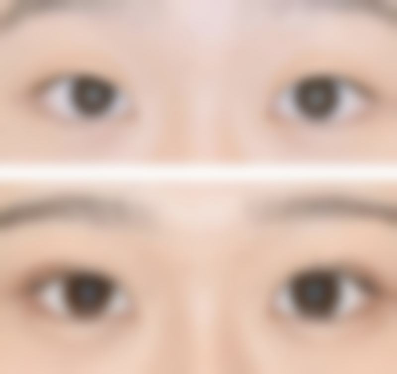 沈阳杏林整形割双眼皮后吃火腿肠怎么样