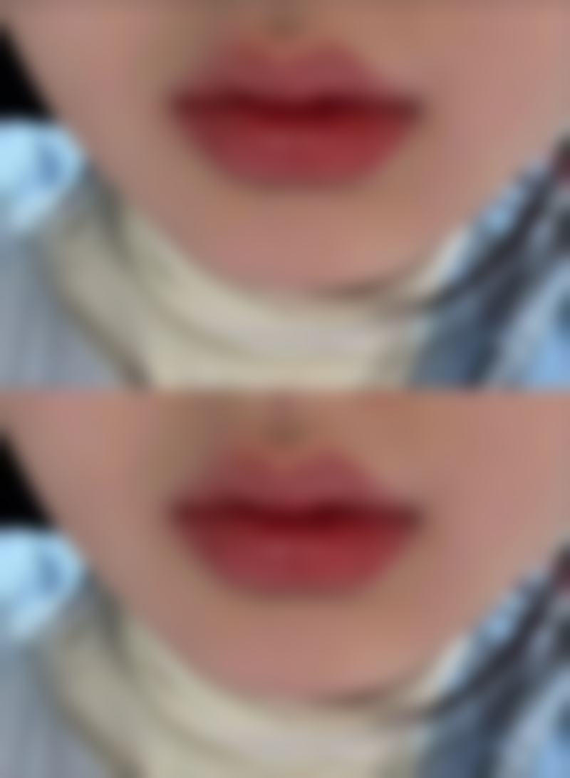 西安莲湖西交疤痕医院治疗疤痕疙瘩硬成效怎么样？