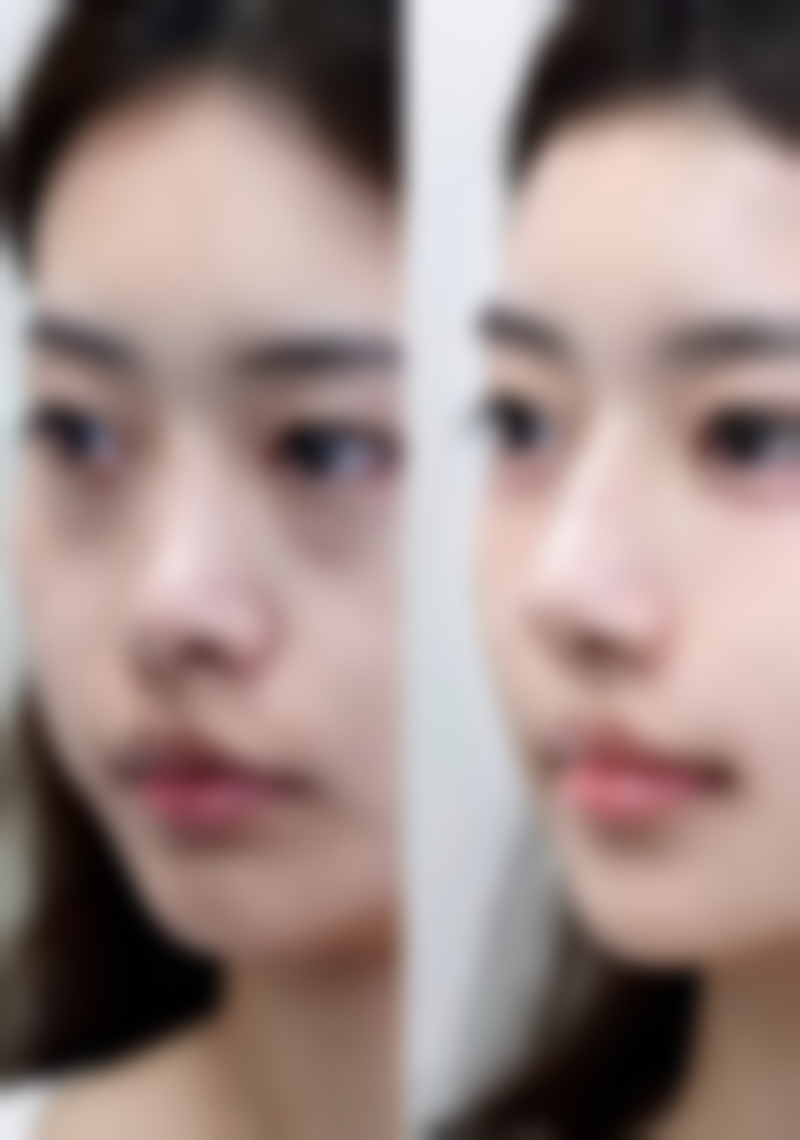 烟台壹颗牙口腔做埋线双眼皮创口情况如何