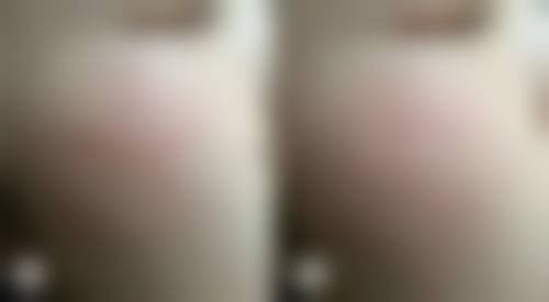 大腿抽脂后淤青修复与医院选择有关吗？