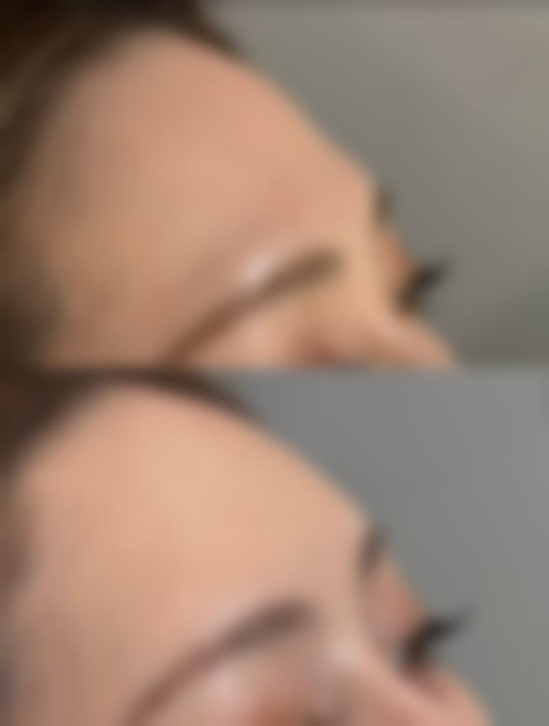 外切祛眼袋正规医院做一次仅需3800元，值不值？北京汉尊口腔医美中 心适合吗？