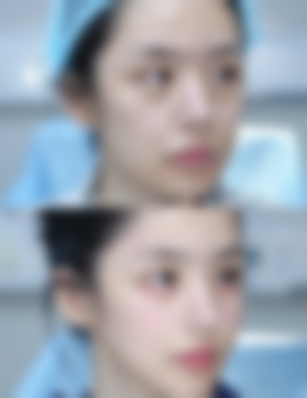 疤痕增生软化后还会复发吗？