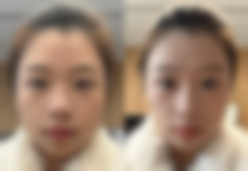 外切祛眼袋能助你轻松告别眼袋吗？杭州普陀维乐口腔医美科靠谱吗？