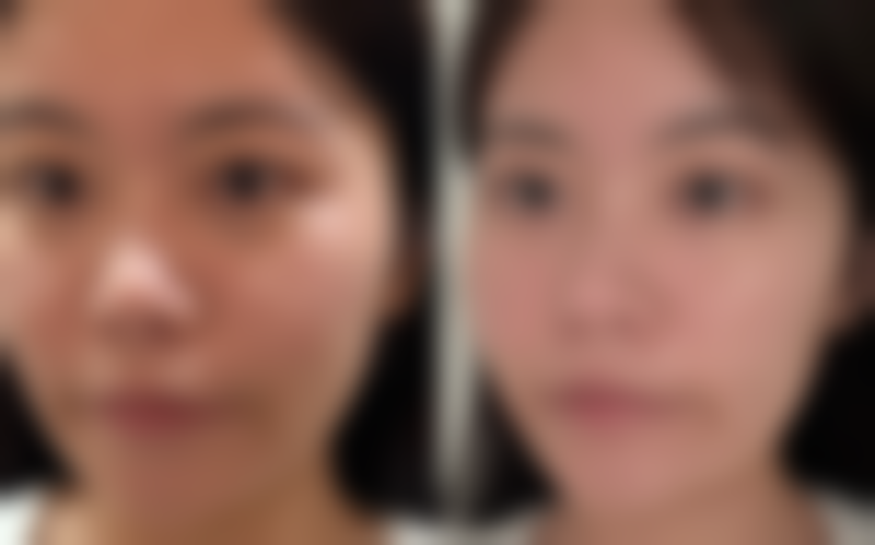 大腿抽脂后淤青修复慢怎么办？