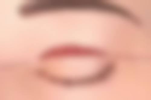 西安米兰柏羽做双眼皮修复自然快吗