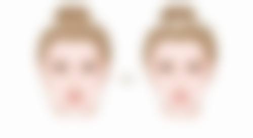 成都米兰柏羽做双眼皮修复自然的时间怎么样