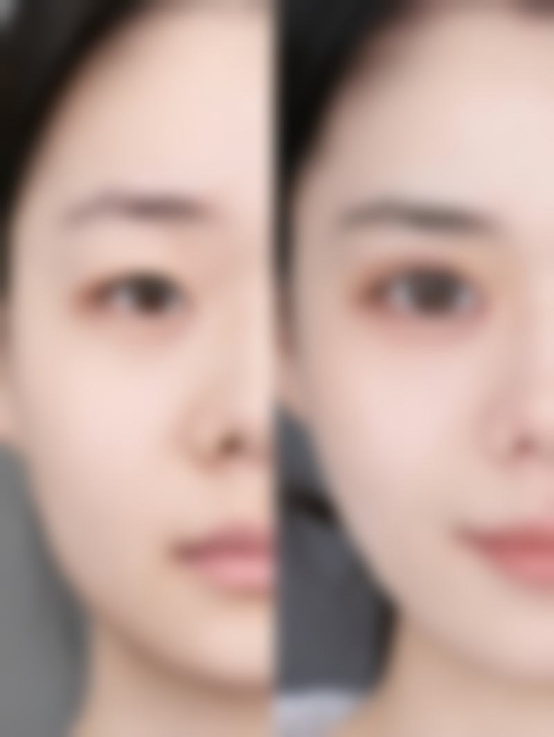 上海爱尚丽格抽脂后皮肤凹凸不平的情况多吗?