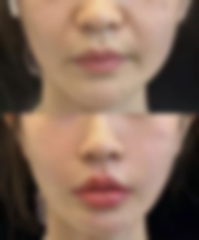 乳香精油去眼袋成效好吗