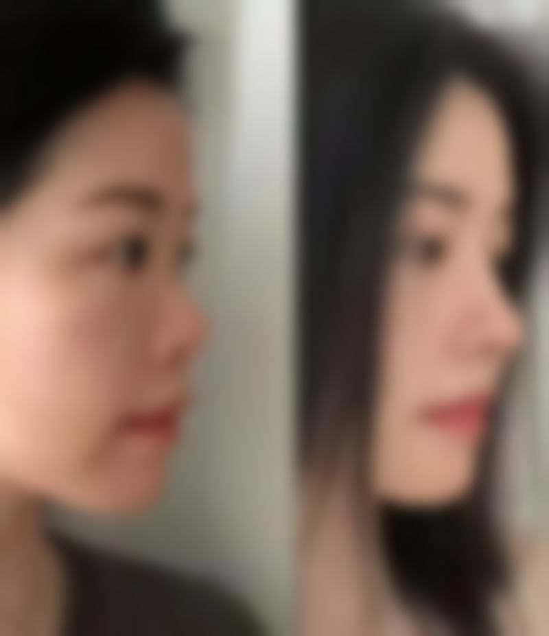 中翰割双眼皮成效自然持久吗