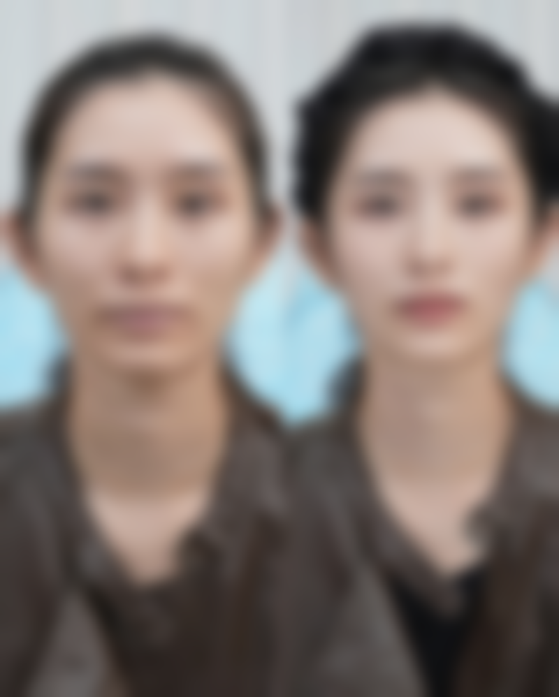 积雪苷霜软膏治疗疤痕疙瘩适合吗