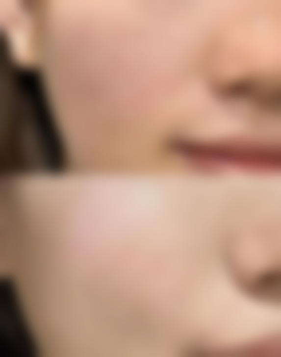 华容县诠美整形医院真实实例