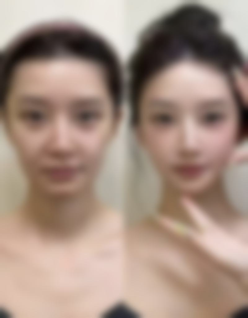 超声法去眼袋在爱尔眼科医院适合吗?