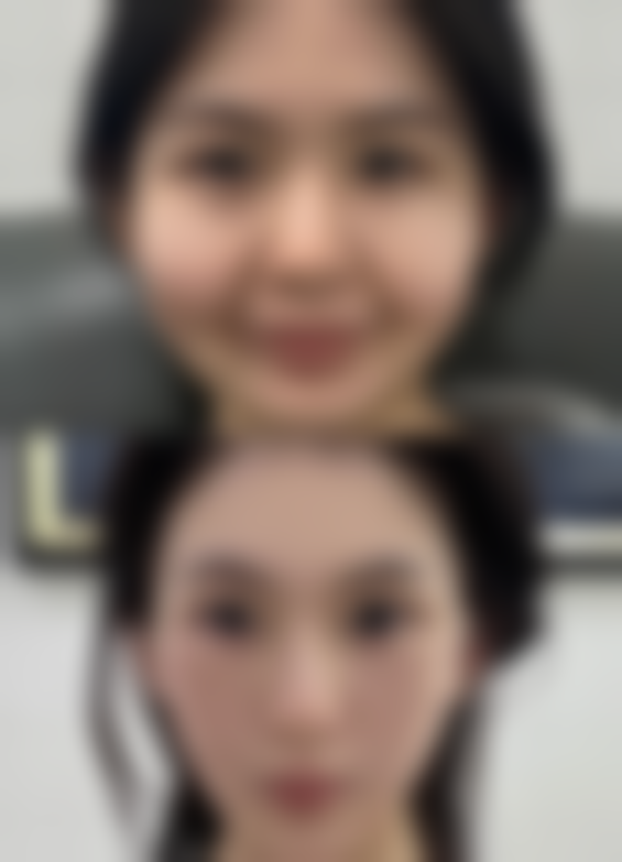 割双眼皮用积雪草苷祛疤膏成效好吗