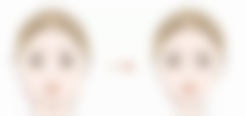 假体取出后做假体隆胸的手术条件怎么样