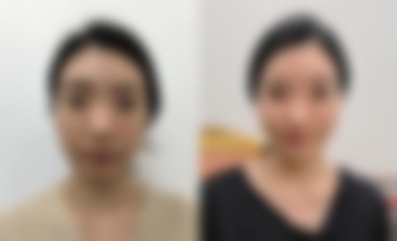 湖北省王文医生的双眼皮手术成效值不值？