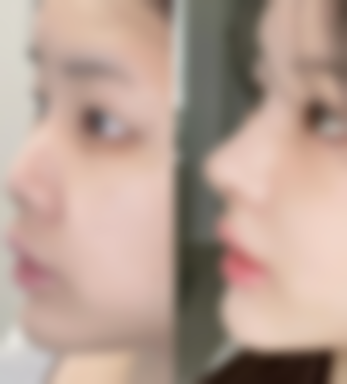 激光祛疤治疗疤痕增生靠谱吗