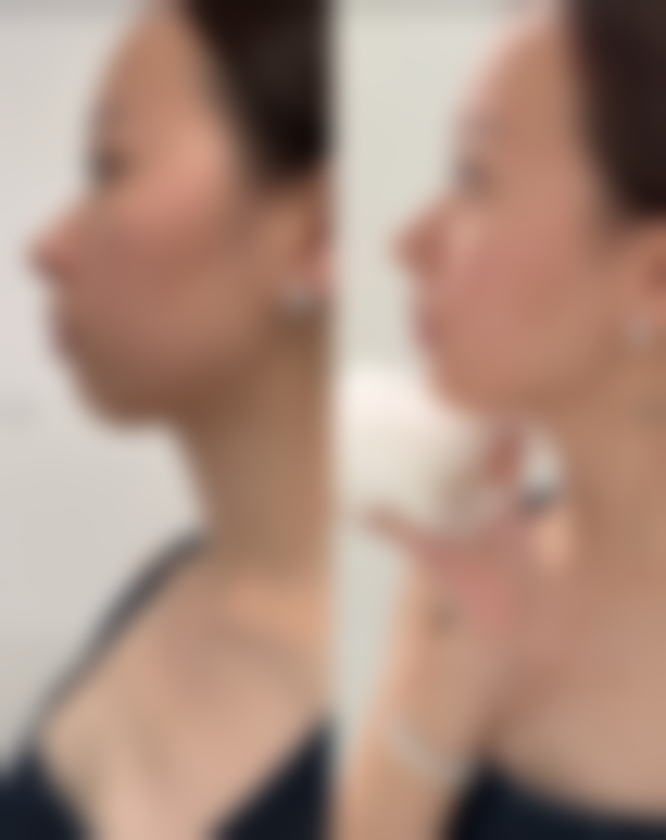 娄底美科整形医疗美容真实实例