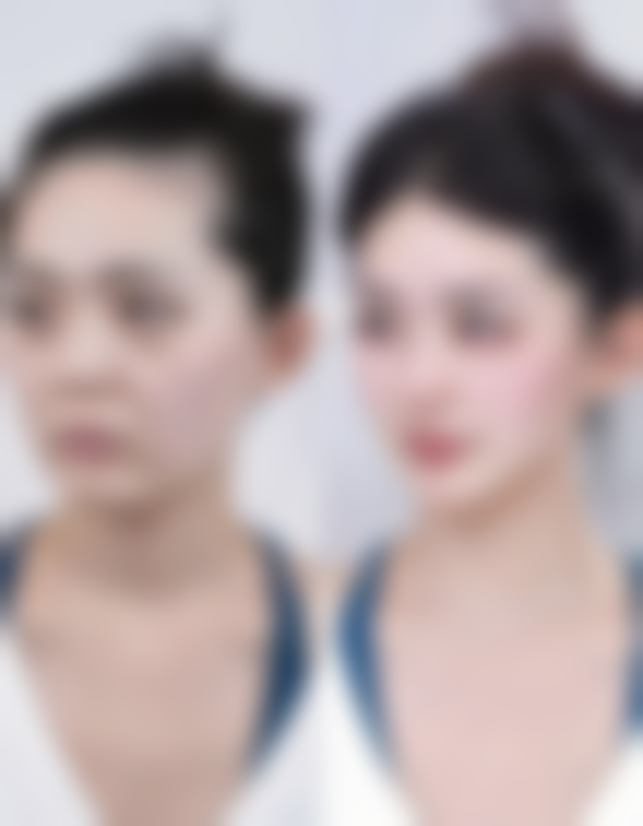 武汉斯启诺医疗美容门诊部王文医生做双眼皮手术收费3800元靠谱吗?