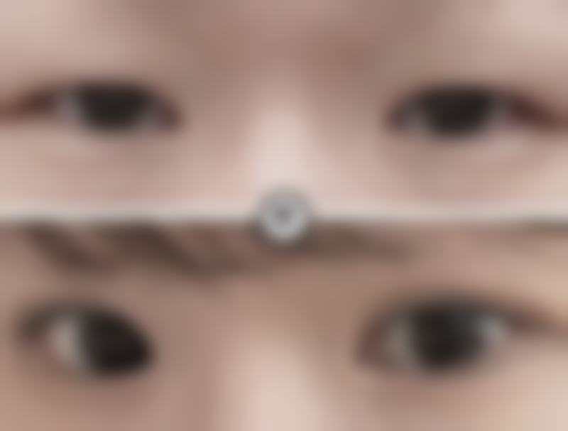 做完双眼皮用祛疤产品靠谱吗