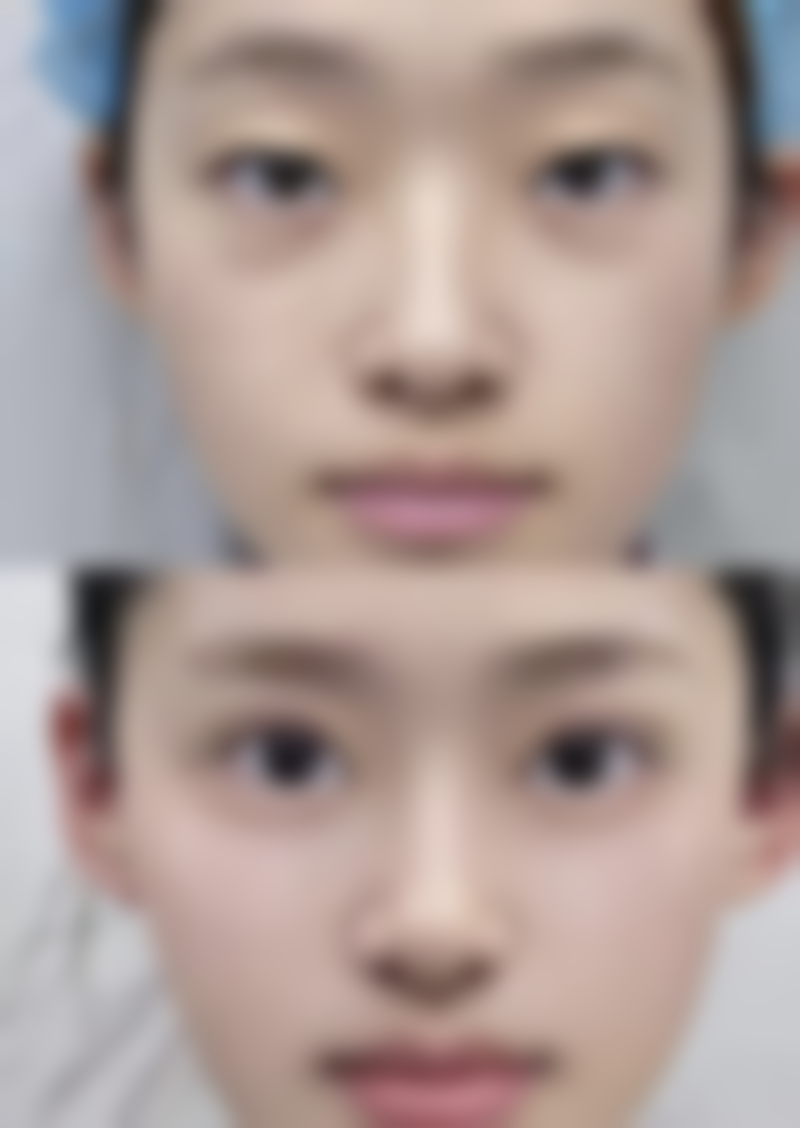 侧切疤痕增生治疗后如何护理