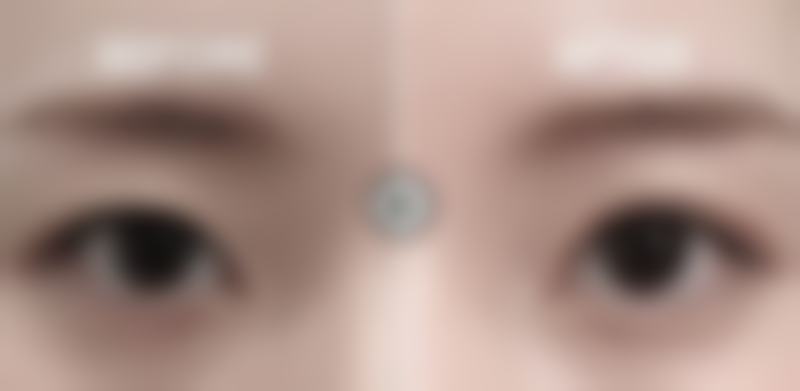 全切双眼皮修复值不值